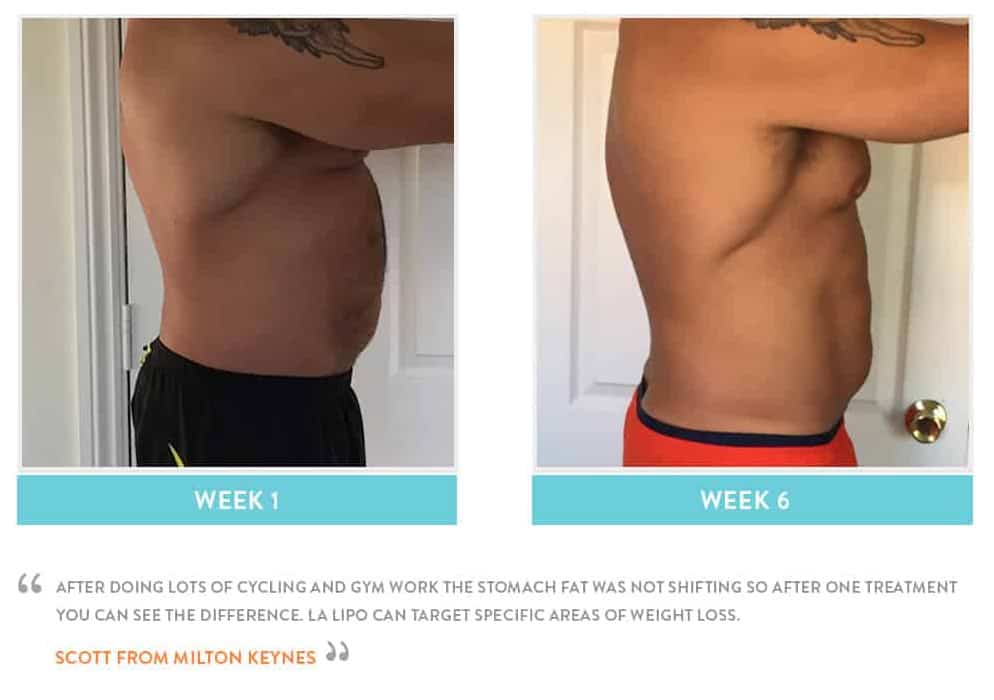 Before & After Stomach Fat West Ruislip