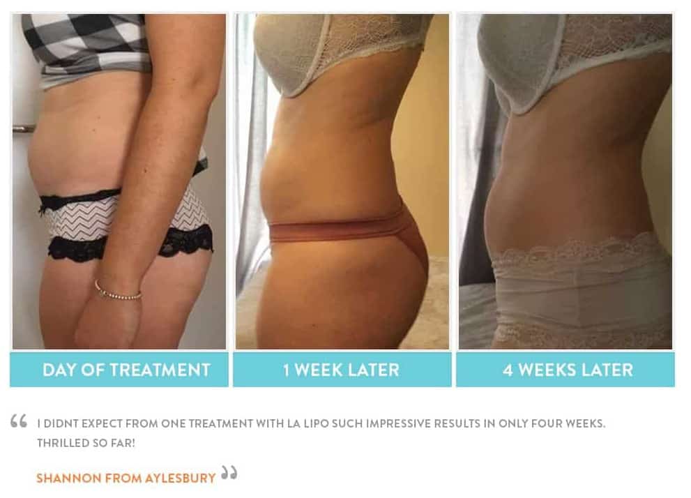 before, Cryolipolysis West Ruislip