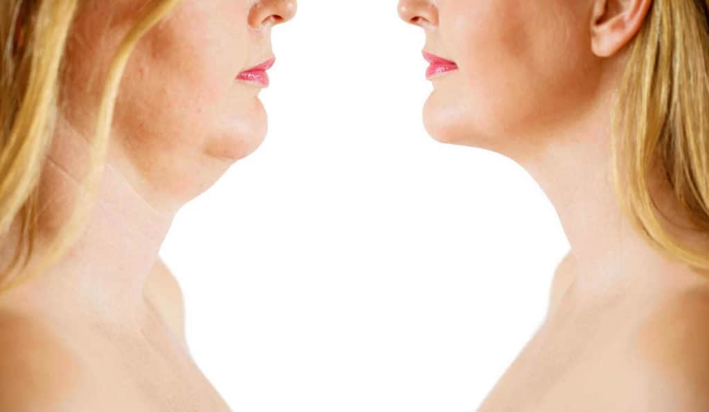 Double Chin treatment West Ruislip before and after results