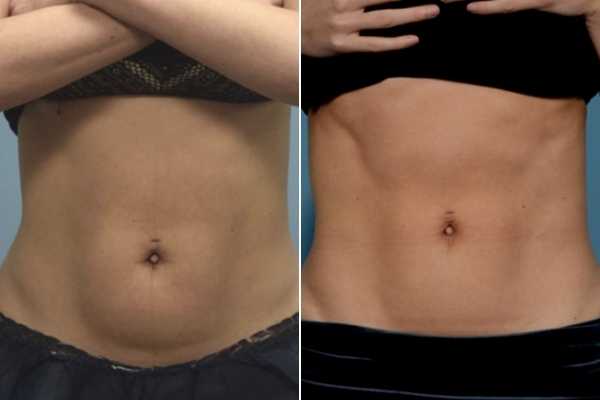 body sculpting FAQs West Ruislip