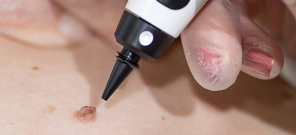 After Skin Tag Removal West Ruislip