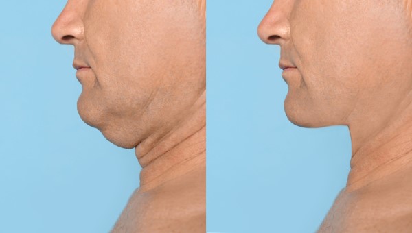 Which Non-Surgical Treatments Work Best for Jowls and Loose Skin West Ruislip?