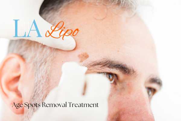 What Are the Most Effective Treatments for Age Spots West Ruislip?