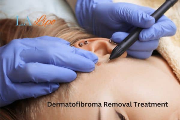 Dermatofibroma Removal Treatment West Ruislip