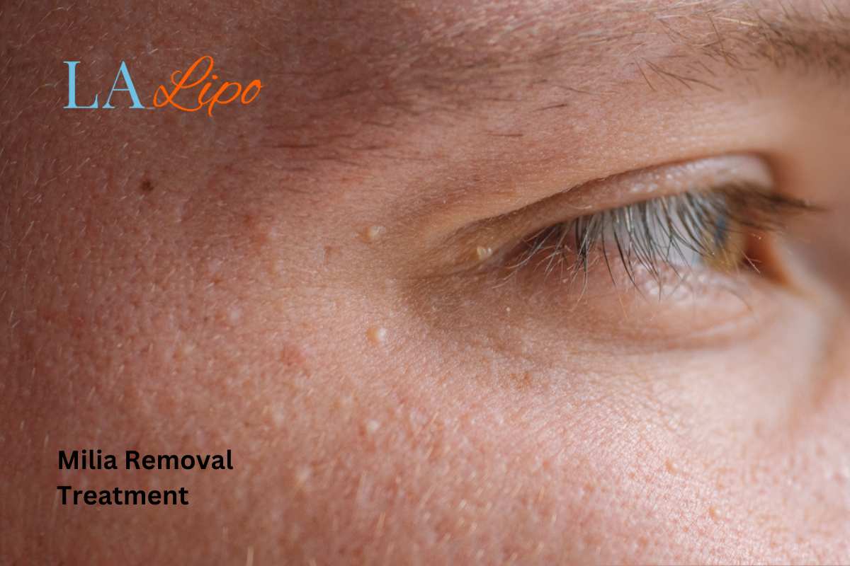 Cryopen Milia Removal: Is It the Easiest and Safest Option West Ruislip?