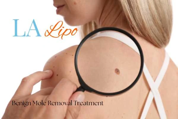 Why getting moles removed West Ruislip can boost your confidence!