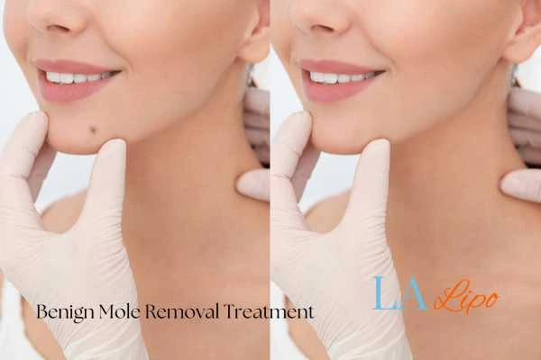 Woman's before and after results of being moles removal treatment West Ruislip