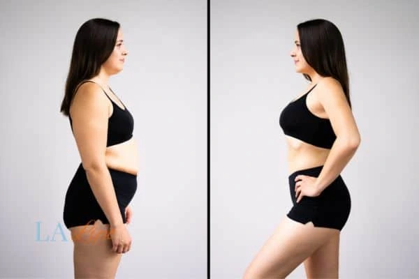 image of woman before and after results of LA-EMS Body Sculpting West Ruislip to help treat Diastasis recti
