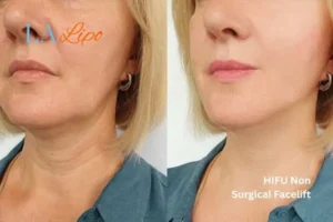 hi-fu for wrinkles West Ruislip before and after results