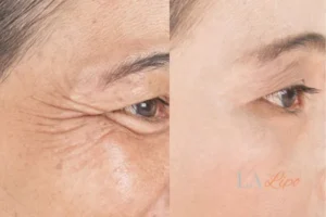 Before and after results of woman - HI-fu wrinkles reduction treatment West Ruislip