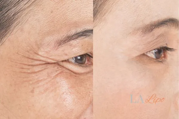 Before and after results of woman - HI-fu wrinkles reduction treatment West Ruislip
