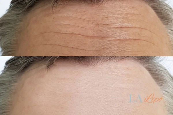results of HIFU West Ruislip on mans forehead to help reduce lines and wrinkles