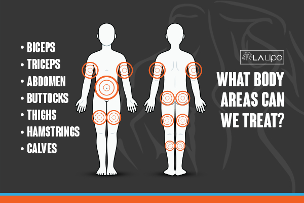 Graphic to show areas you can have LA-EMS Body Sculpting West Ruislip treatment.