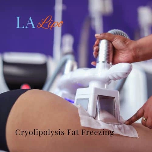 fat freezing - Cryolipolysis West Ruislip