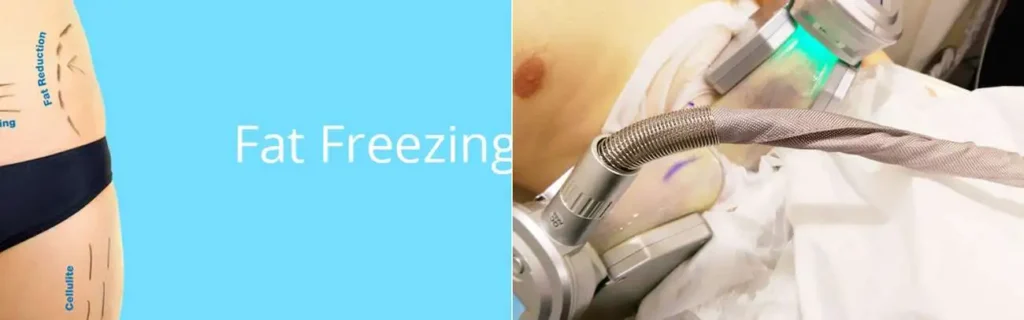 multi areas of a persons body having coolsculpting West Ruislip treatment