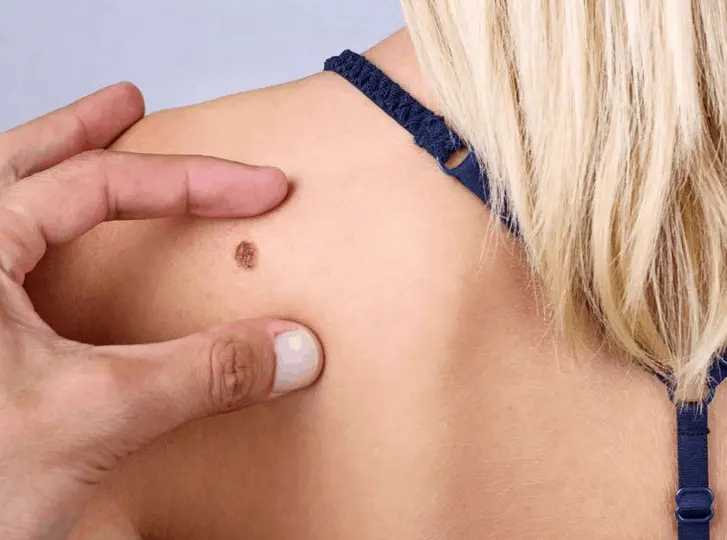 woman having mole removal West Ruislip consultation before treatment.