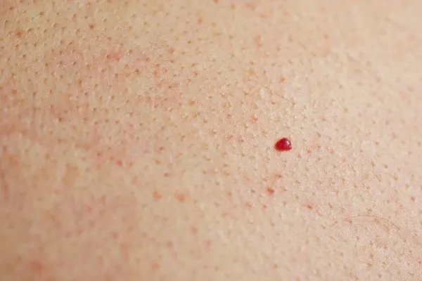 close up of a cherry angioma West Ruislip