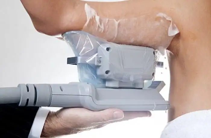 Picture of fat freezing West Ruislip on the upper arms.