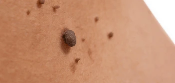 image of a skin tag West Ruislip