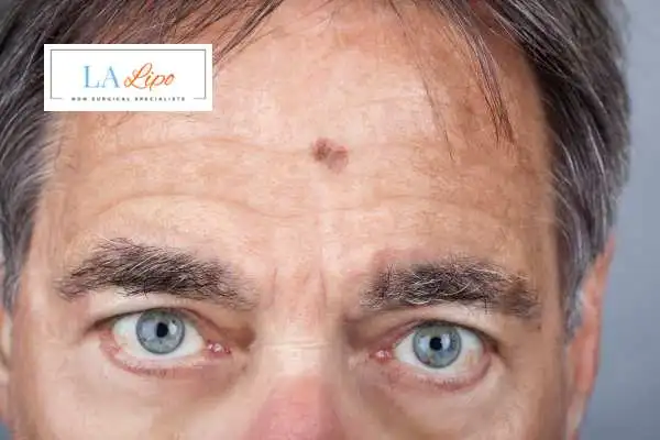 Solar Lentigo Removal West Ruislip image of man with mark on his forehead