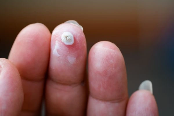 wart on person finger - cryotherapy to treat from LA LIPO West Ruislip