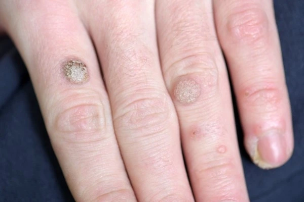 photo of warts on person hand - see wart removal West Ruislip from LA LIPO