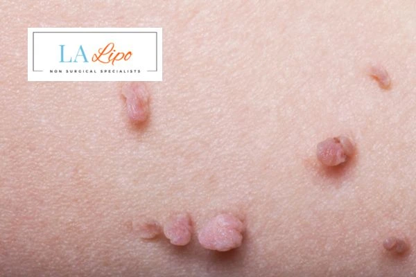 Does cryopen skin tag removal West Ruislip hurt? Find out now call our team today!