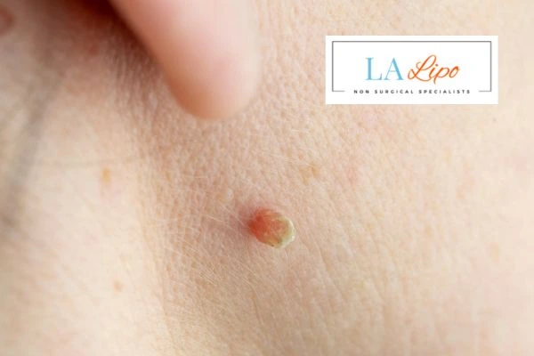 Book skin tag removal West Ruislip today speak to our team now!