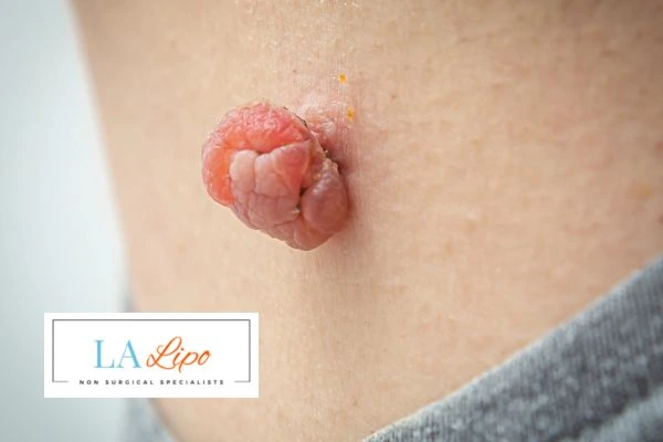 Interested in skin tag removal West Ruislip? Concerned about the pain? Find out more today!