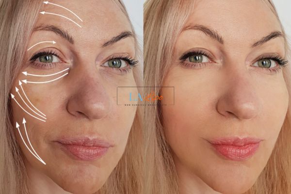 Morpheus 8 results West Ruislip face lift.