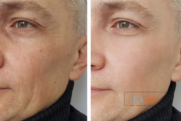 See the amazing results of Morpheus8 Treatment West Ruislip!