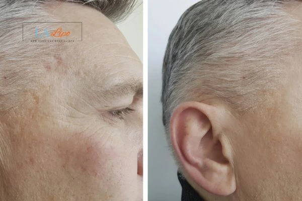 Mens Before & After Morpheus 8 Results West Ruislip