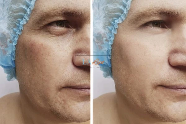 Before and after Morpheus 8 Results West Ruislip