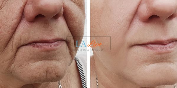 Older lady deeper wrinkle reduction - LA LIPO Morpheus 8 Results West Ruislip