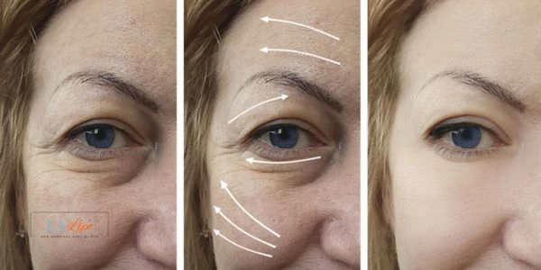 Amazing eye lift Morpheus 8 results West Ruislip