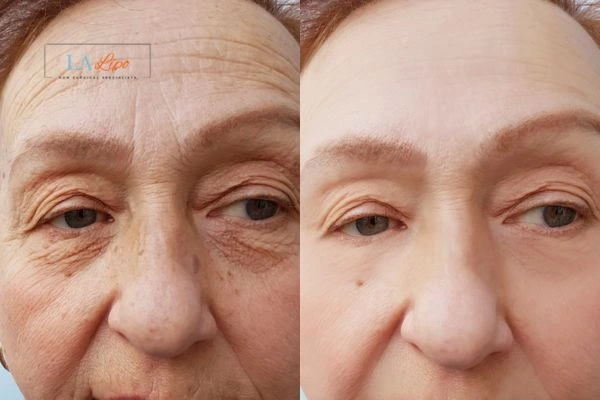 The powerful benefits of Morpheus8 Treatment West Ruislip - Call Our team today!