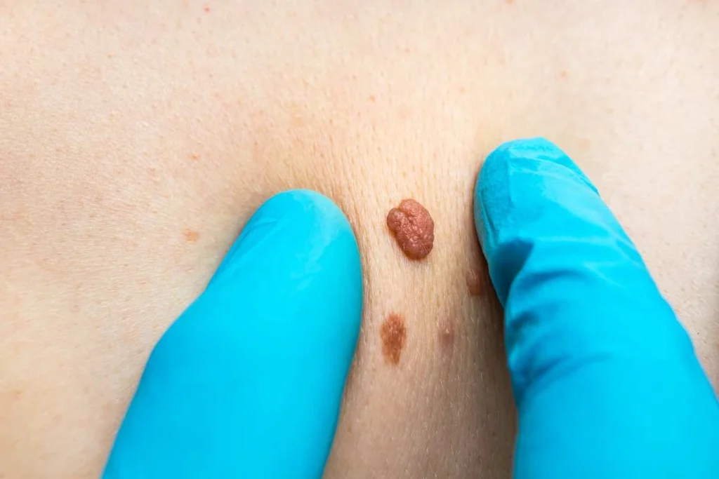 LA LIPO Cryopen Lesion Removal Prices West Ruislip