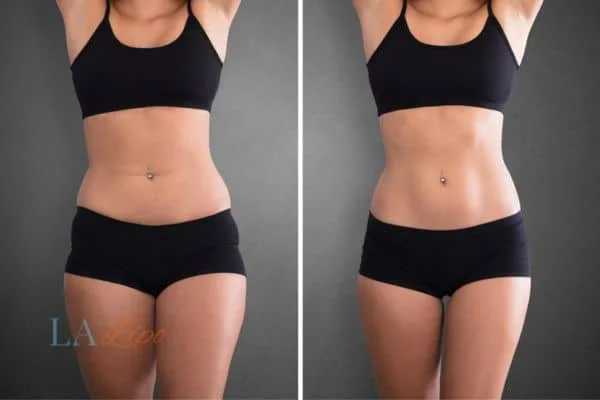 before and after results of non-surgical treatment to help a woman's body image and mental health West Ruislip