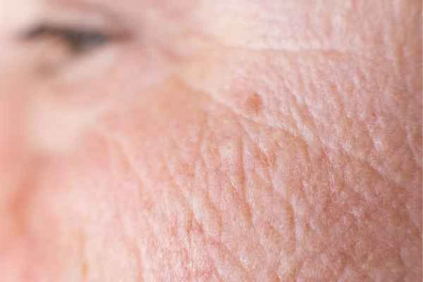 close up picture of a woman's face showing an age spot West Ruislip