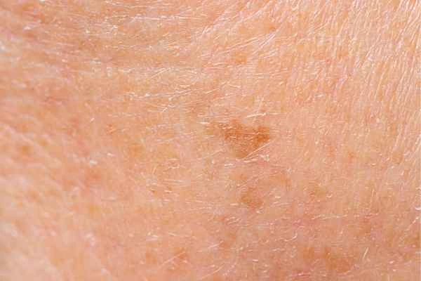 close up picture of age spots West Ruislip