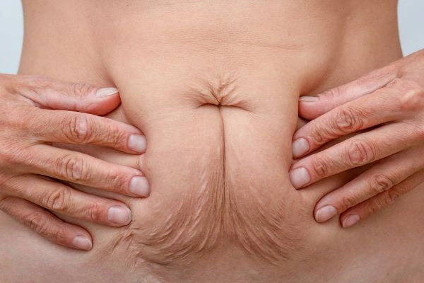 Image of a woman's stomach with loose skin - example of skin tightening West Ruislip options