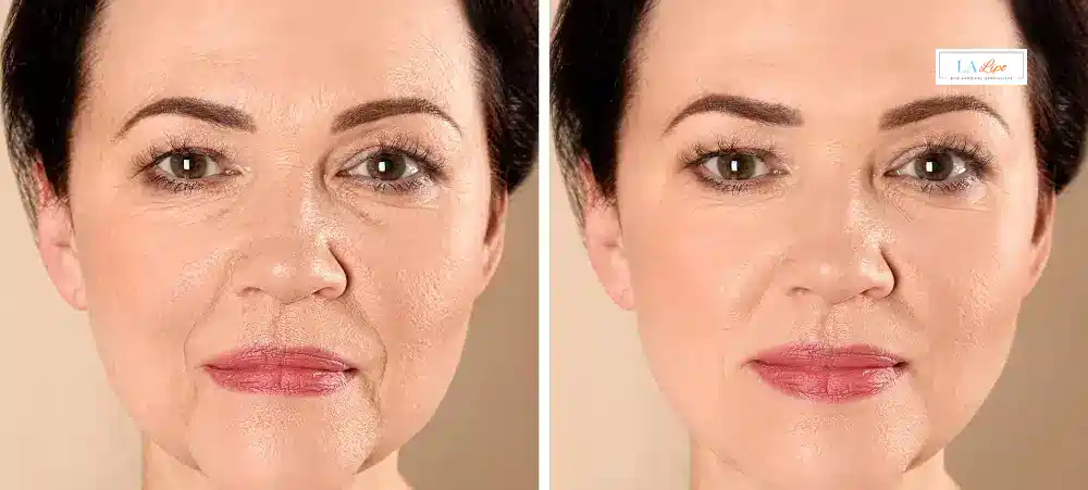 How Long Does It Take to See Results and How Long Do They Last West Ruislip?