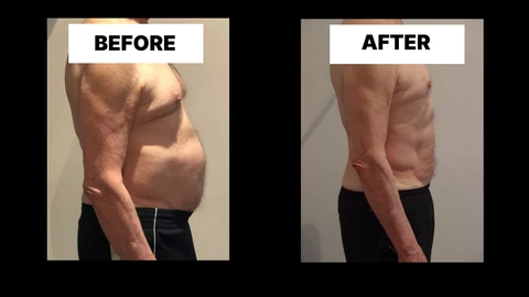 What Symptoms Can Diastasis Recti Cause in Men? Weak Core, Back Pain and Poor Posture West Ruislip